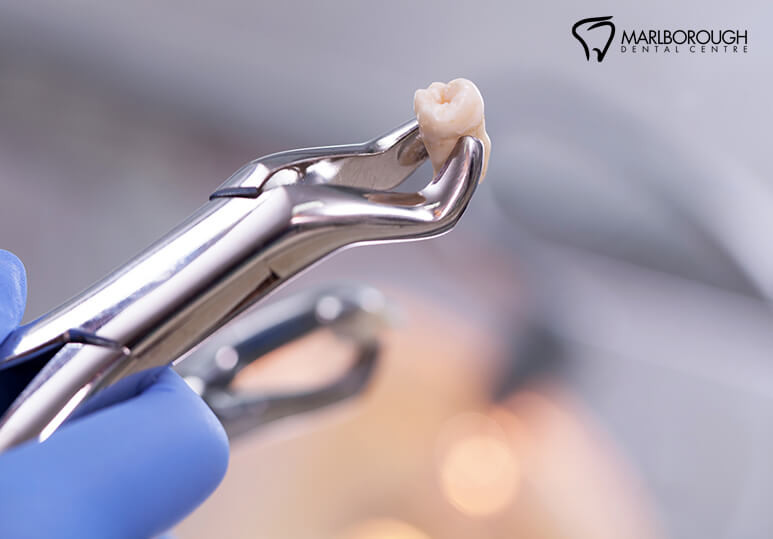 marlborough dental - blog - 5 Reasons Why Wisdom Teeth Need To Be Removed